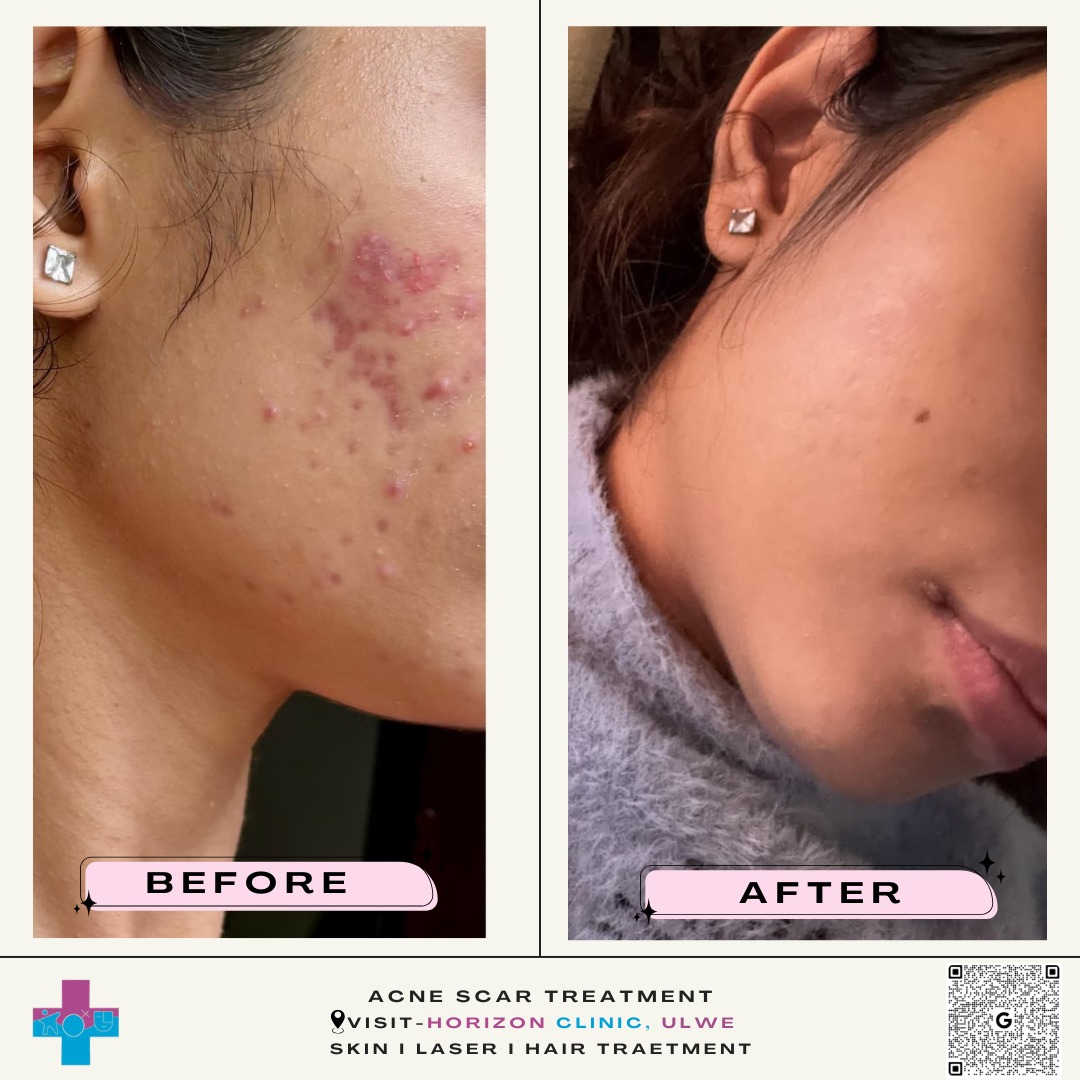 Acne Scar Resurfacing